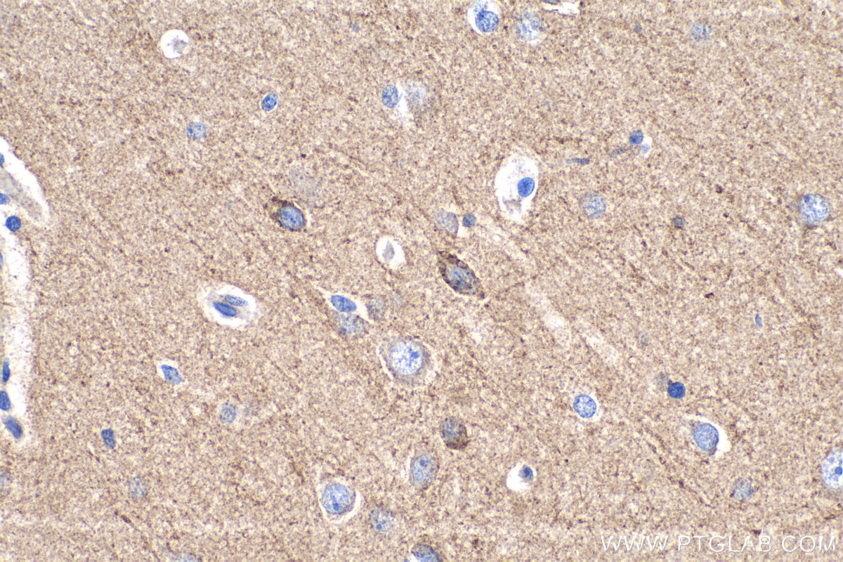 IHC staining of human gliomas using 15270-1-AP
