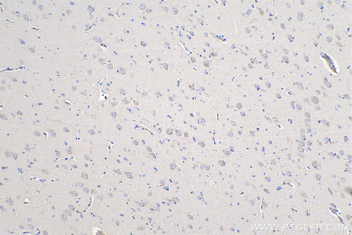 IHC staining of human gliomas using 12853-1-AP