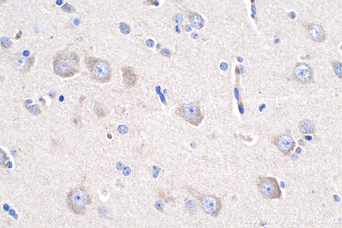Immunohistochemistry (IHC) staining of human gliomas tissue using PCDHA6 Polyclonal antibody (12853-1-AP)
