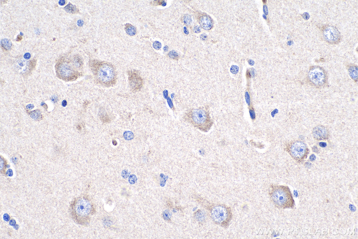 IHC staining of human gliomas using 12853-1-AP