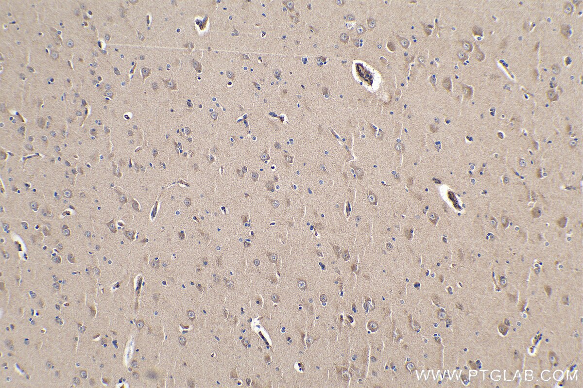 Immunohistochemistry (IHC) staining of human gliomas tissue using PCDHB10 Polyclonal antibody (14785-1-AP)
