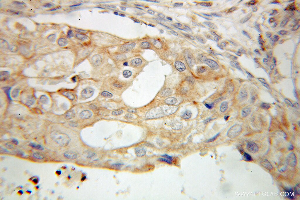 Immunohistochemistry (IHC) staining of human breast cancer tissue using PCDHGC3 Polyclonal antibody (10857-1-AP)