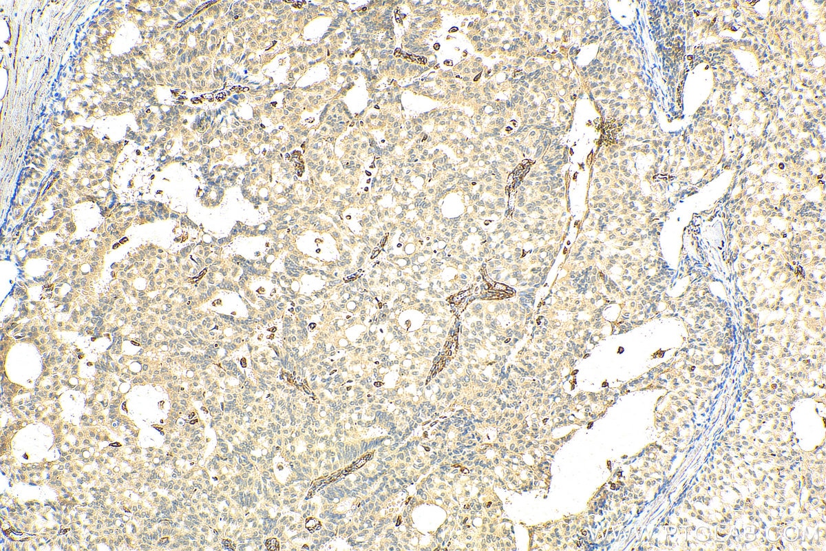 Immunohistochemistry (IHC) staining of human breast hyperplasia tissue using PCID2 Polyclonal antibody (26638-1-AP)