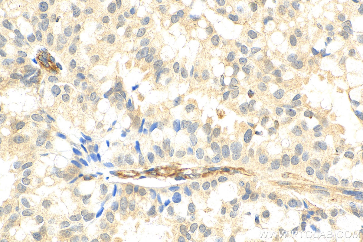 Immunohistochemistry (IHC) staining of human breast hyperplasia tissue using PCID2 Polyclonal antibody (26638-1-AP)