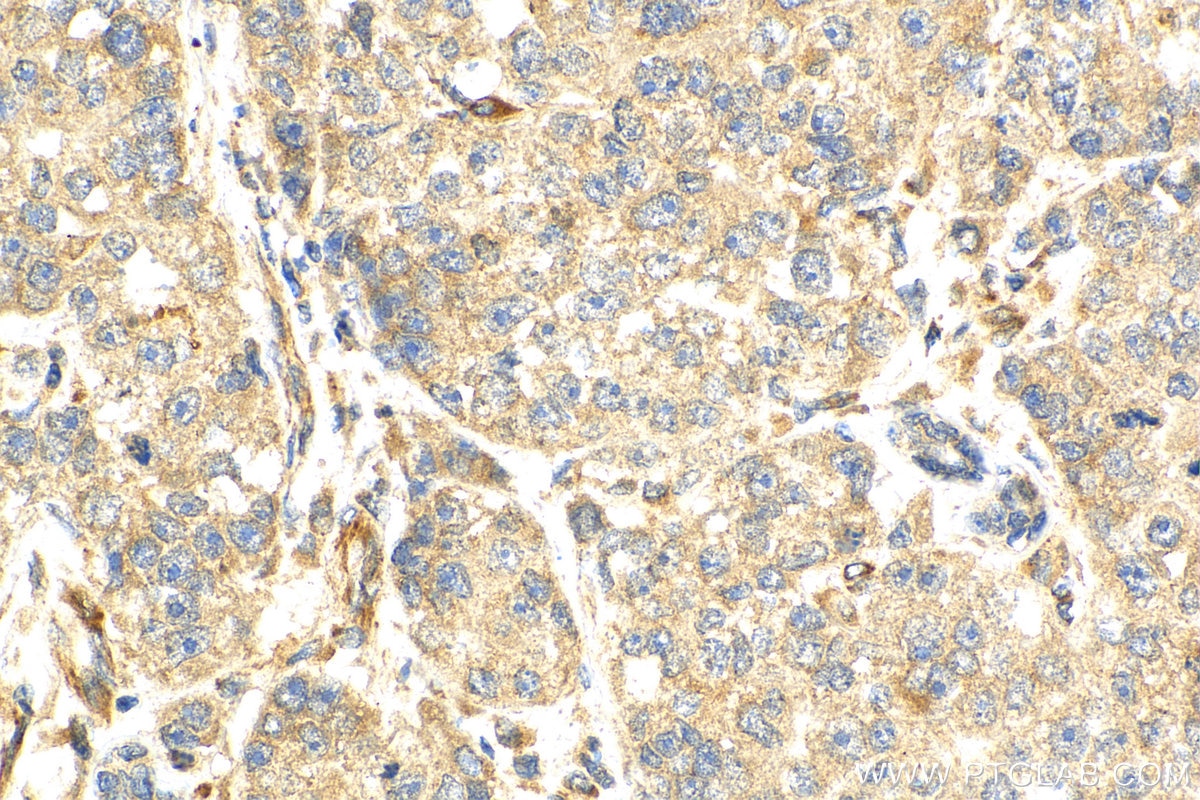 Immunohistochemistry (IHC) staining of human breast cancer tissue using PCID2 Polyclonal antibody (26638-1-AP)