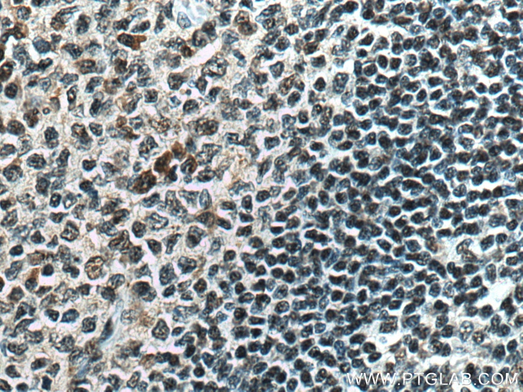 Immunohistochemistry (IHC) staining of human tonsillitis tissue using PCIF1 Polyclonal antibody (16082-1-AP)