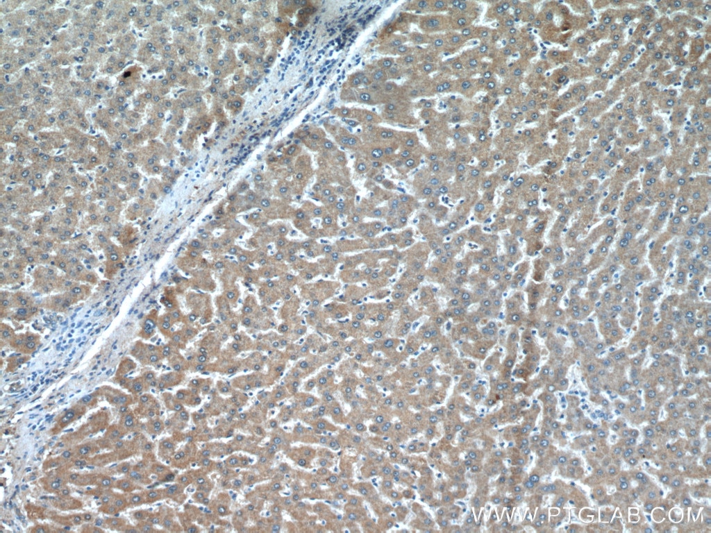 Immunohistochemistry (IHC) staining of human liver cancer tissue using PCK2 Polyclonal antibody (14892-1-AP)