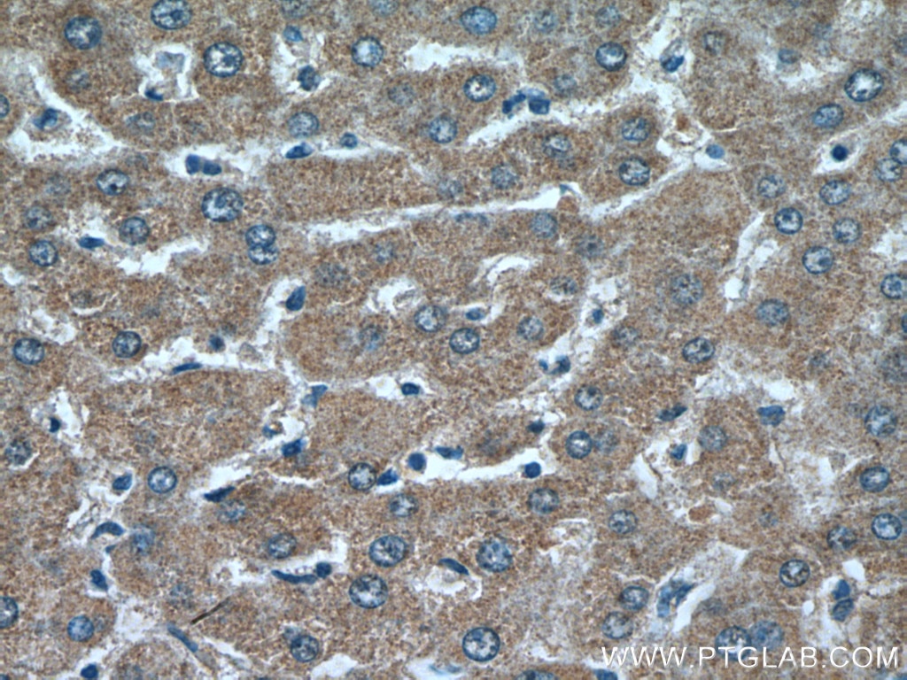 Immunohistochemistry (IHC) staining of human liver cancer tissue using PCK2 Polyclonal antibody (14892-1-AP)
