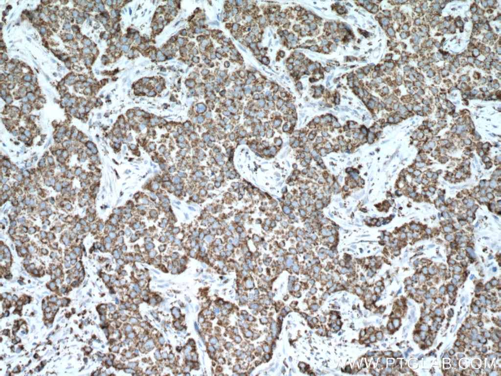Immunohistochemistry (IHC) staining of human breast cancer tissue using PCK2 Polyclonal antibody (14892-1-AP)