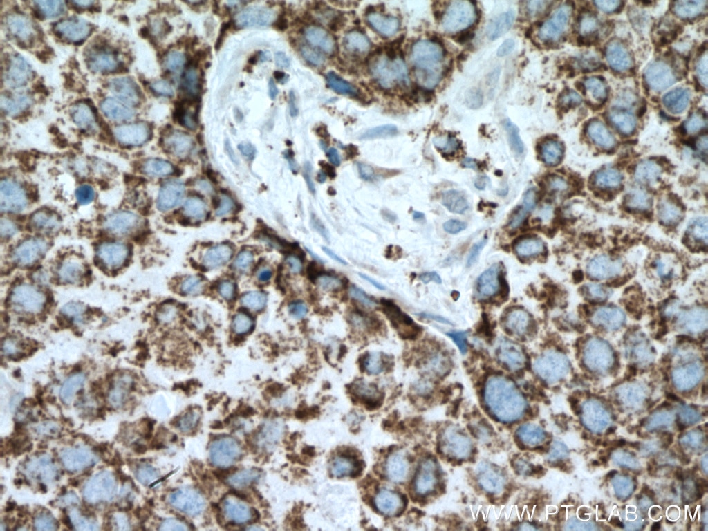 Immunohistochemistry (IHC) staining of human breast cancer tissue using PCK2 Polyclonal antibody (14892-1-AP)