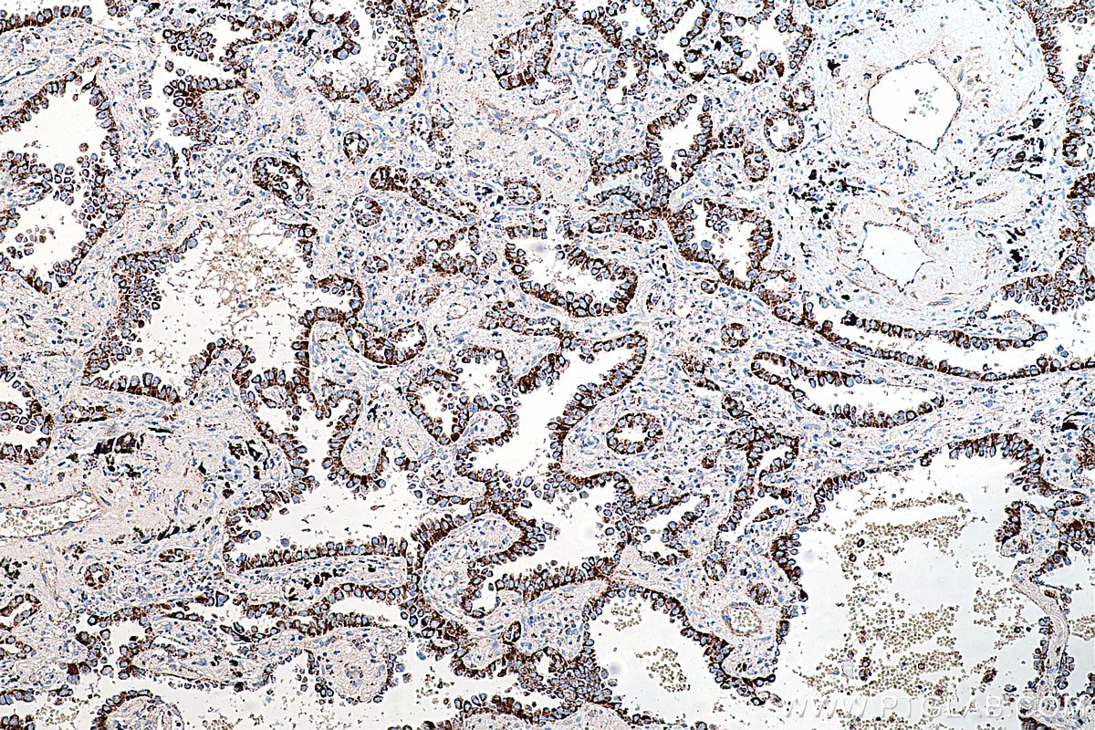 Immunohistochemistry (IHC) staining of human lung cancer tissue using PCK2 Monoclonal antibody (67676-1-Ig)