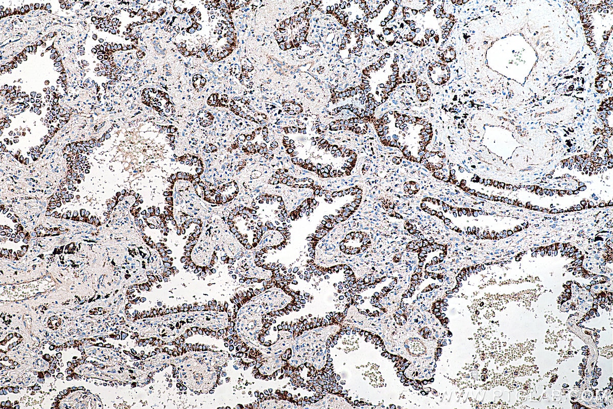 IHC staining of human lung cancer using 67676-1-Ig