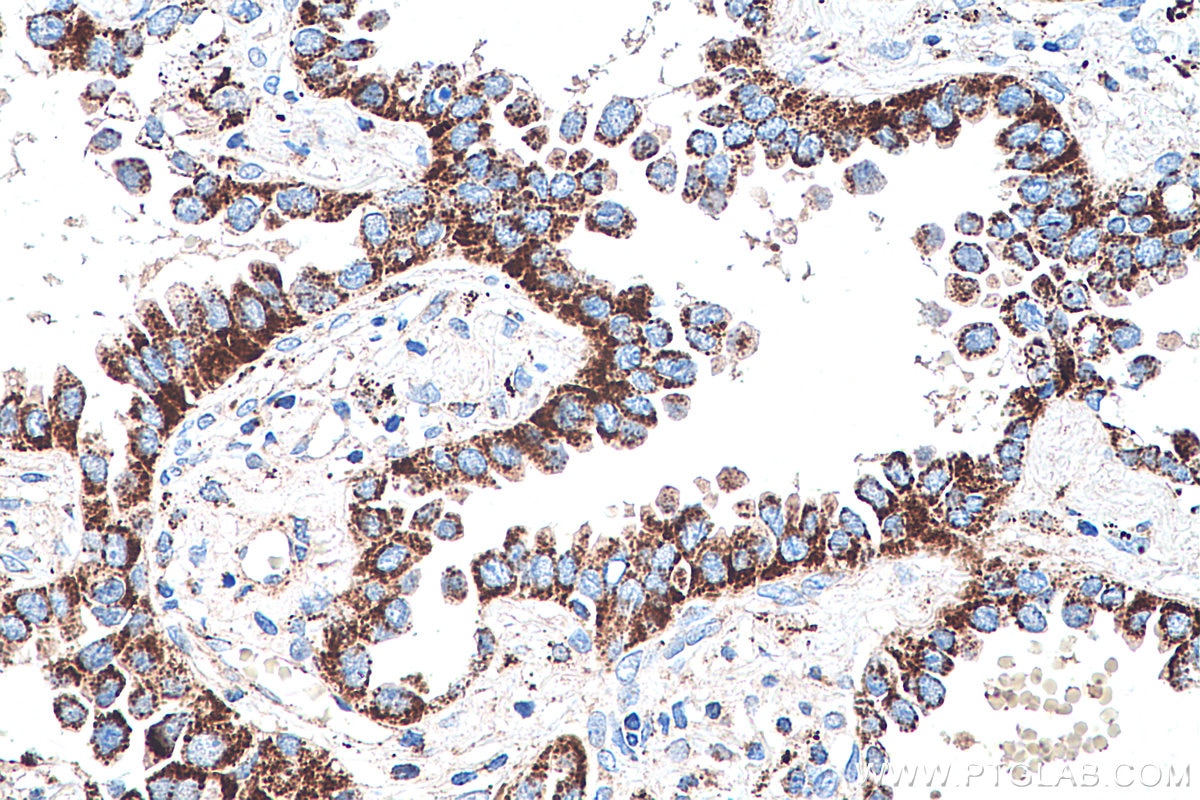 IHC staining of human lung cancer using 67676-1-Ig