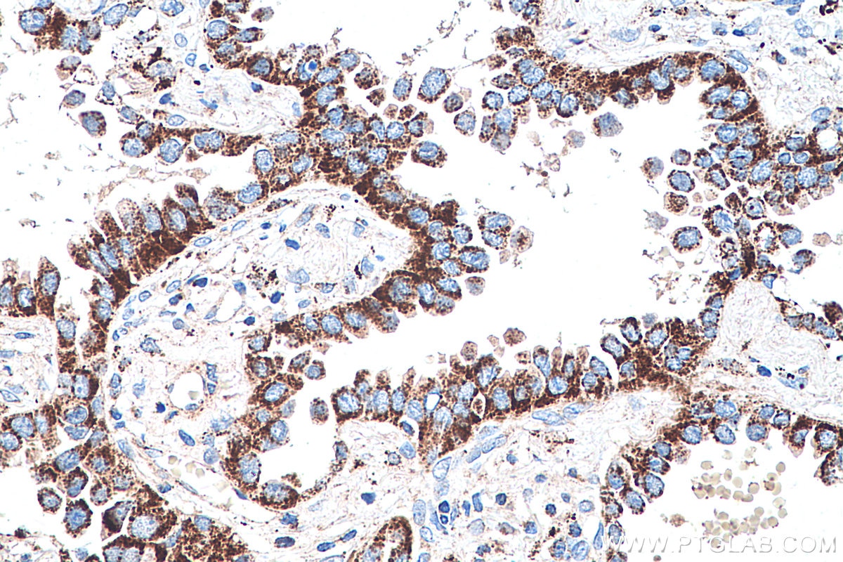 Immunohistochemistry (IHC) staining of human lung cancer tissue using PCK2 Monoclonal antibody (67676-1-Ig)