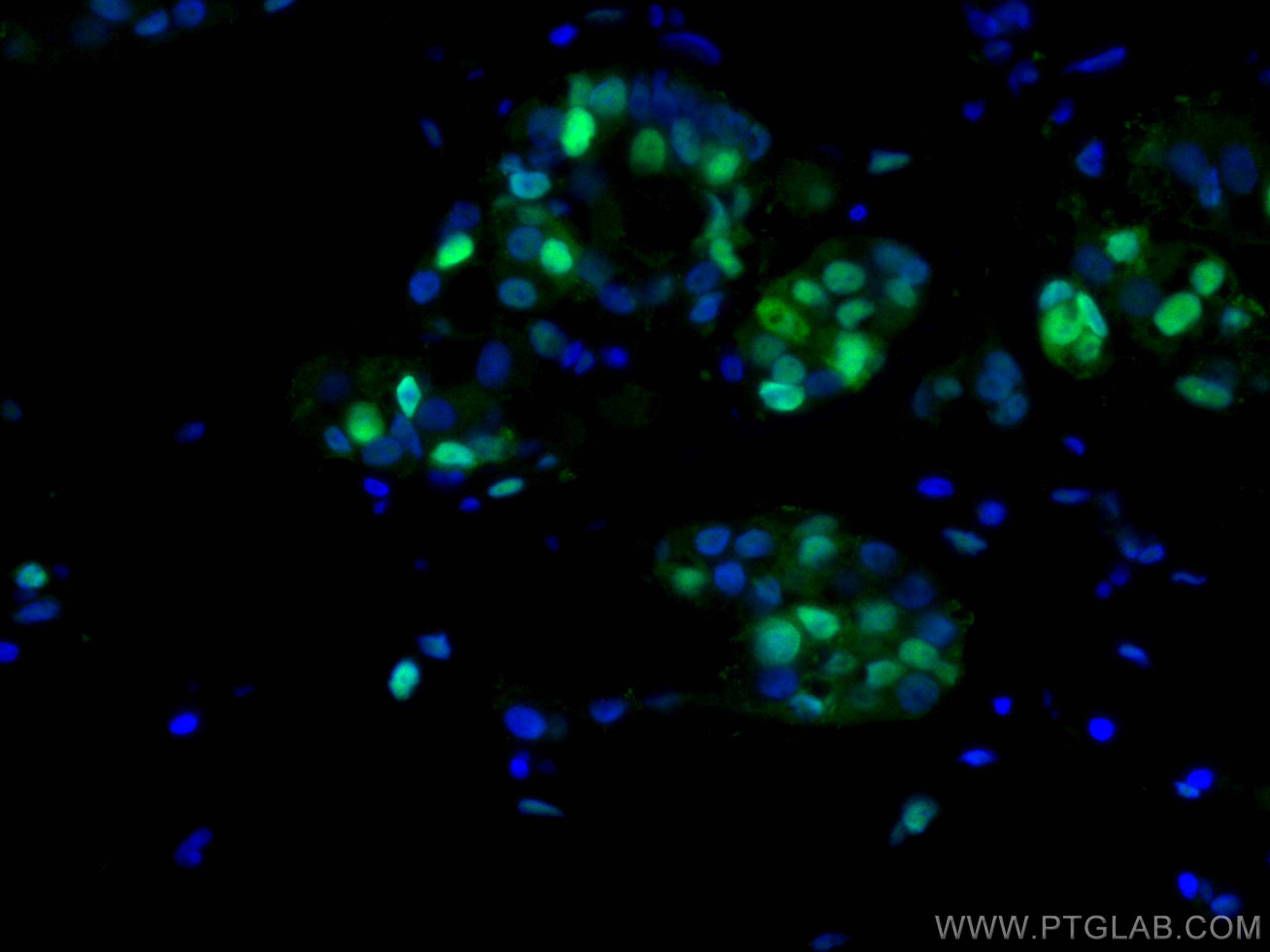 IF Staining of human breast cancer using 10205-2-AP