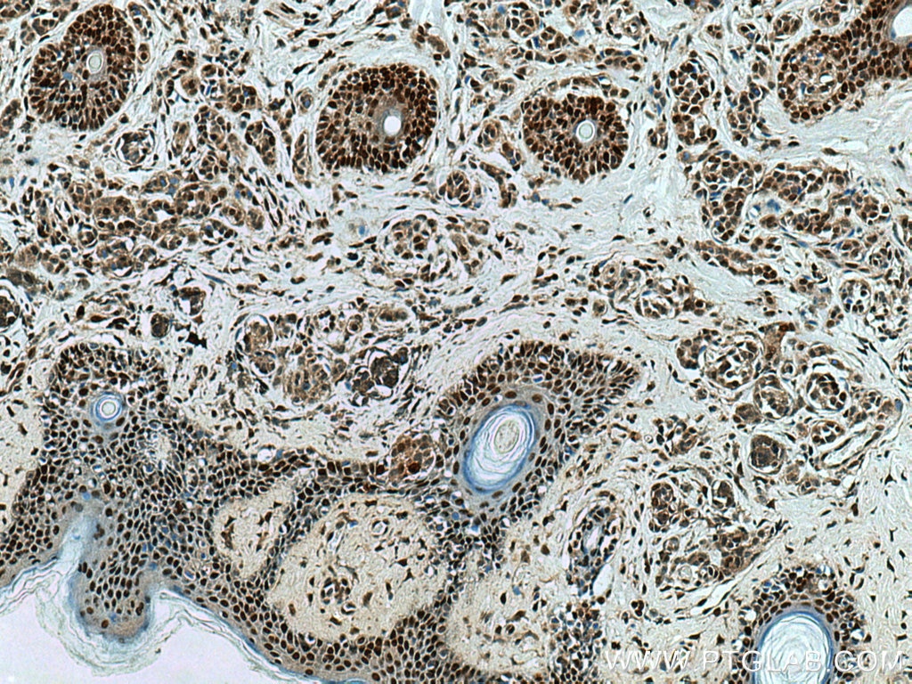 Immunohistochemistry (IHC) staining of human malignant melanoma tissue using PCNA Polyclonal antibody (10205-2-AP)