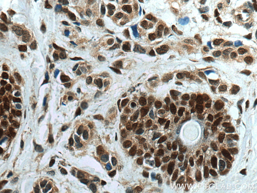 Immunohistochemistry (IHC) staining of human malignant melanoma tissue using PCNA Polyclonal antibody (10205-2-AP)