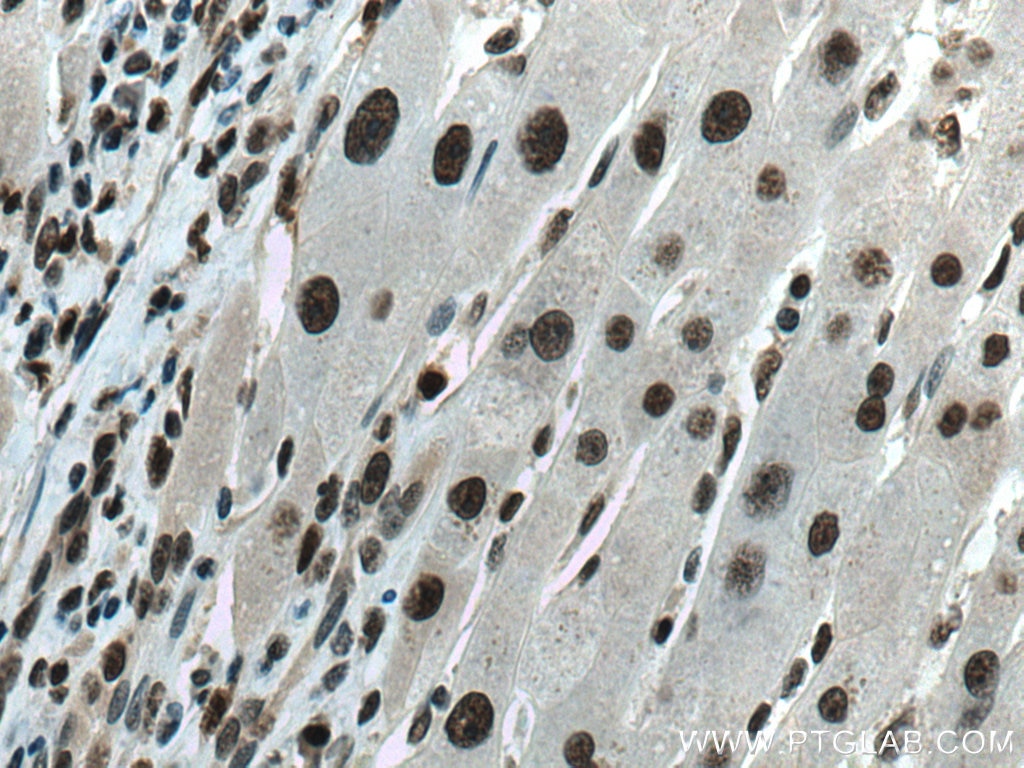 Immunohistochemistry (IHC) staining of human liver cancer tissue using PCNA Polyclonal antibody (10205-2-AP)