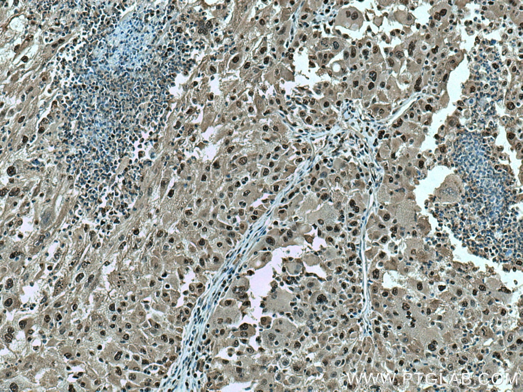 Immunohistochemistry (IHC) staining of human liver cancer tissue using PCNA Polyclonal antibody (10205-2-AP)