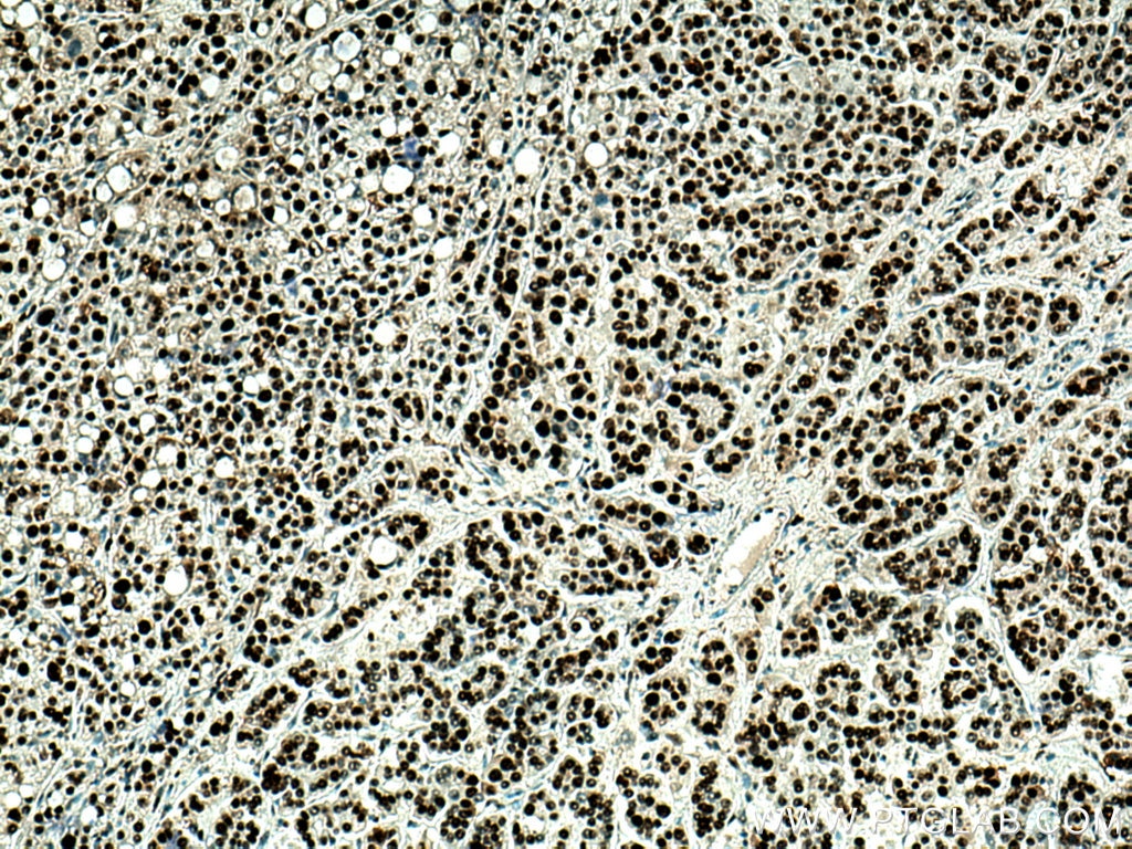 Immunohistochemistry (IHC) staining of human liver cancer tissue using PCNA Polyclonal antibody (10205-2-AP)
