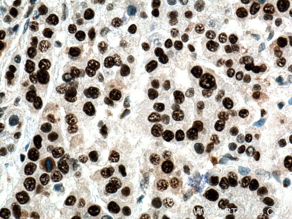 Immunohistochemistry (IHC) staining of human liver cancer tissue using PCNA Polyclonal antibody (10205-2-AP)