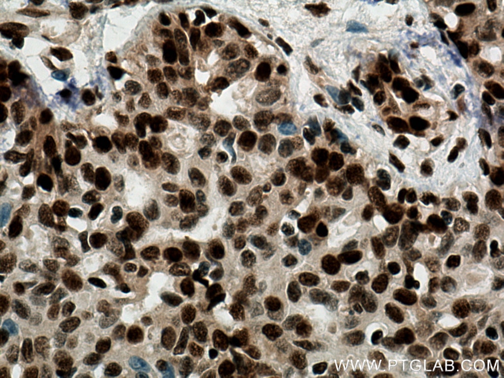 Immunohistochemistry (IHC) staining of human breast cancer tissue using PCNA Polyclonal antibody (10205-2-AP)