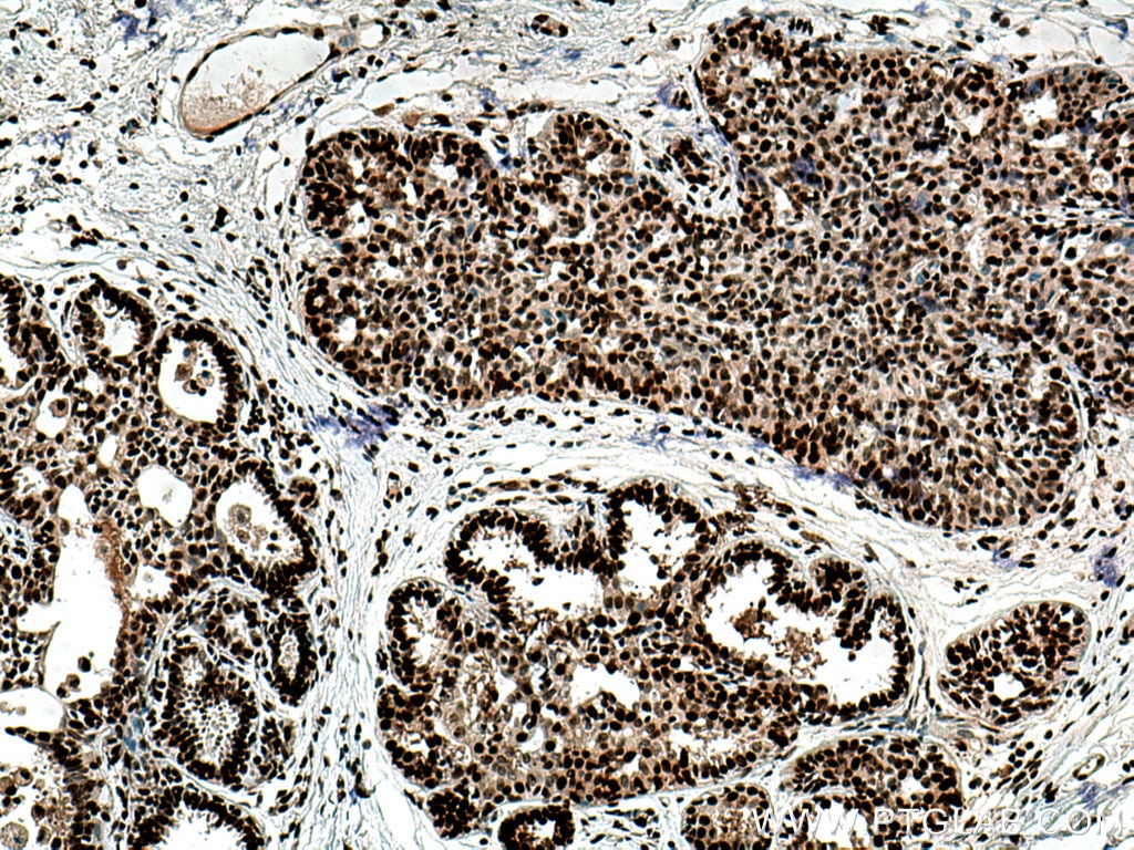 Immunohistochemistry (IHC) staining of human breast cancer tissue using PCNA Polyclonal antibody (10205-2-AP)