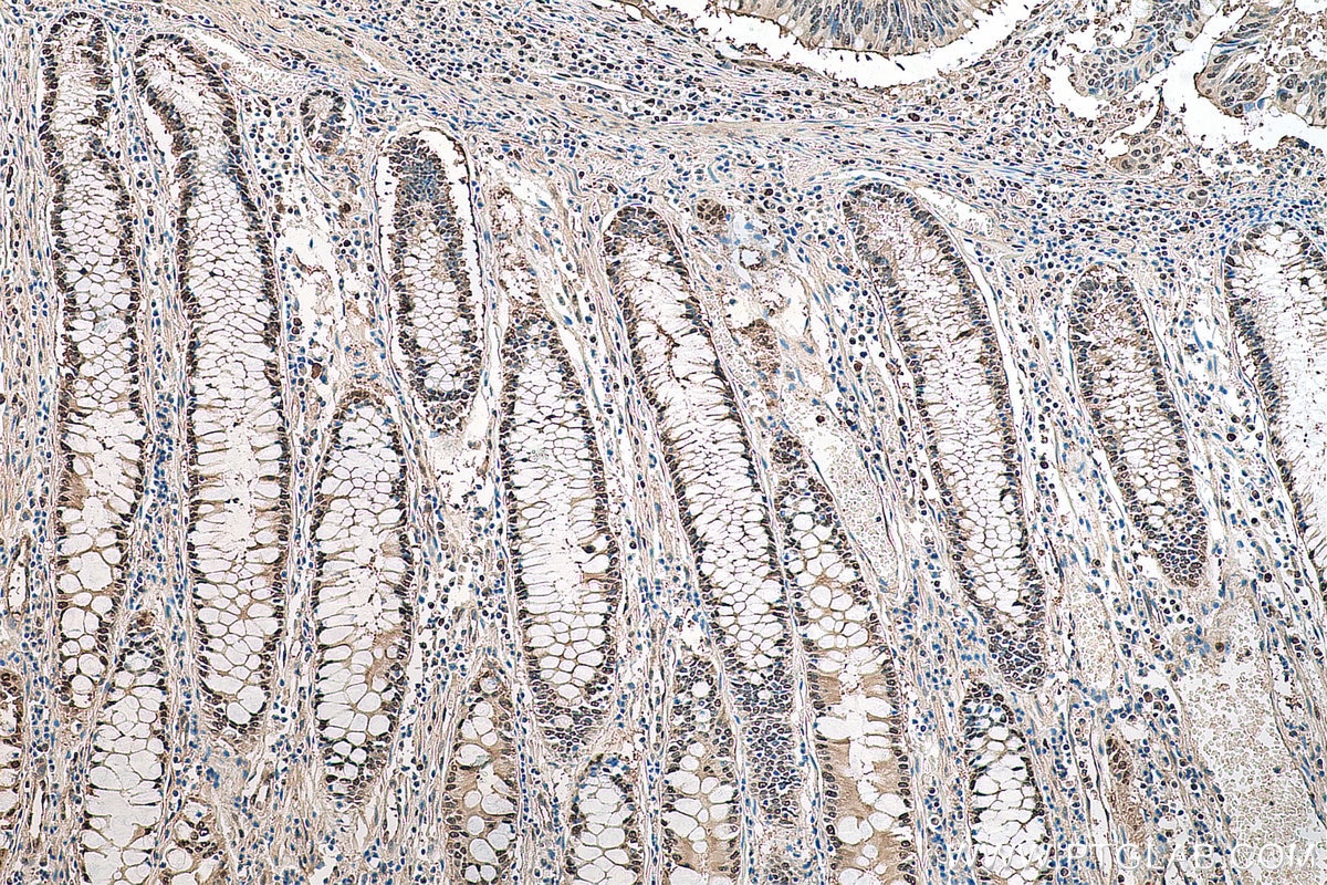 Immunohistochemistry (IHC) staining of human colon cancer tissue using PCNA Polyclonal antibody (10205-2-AP)
