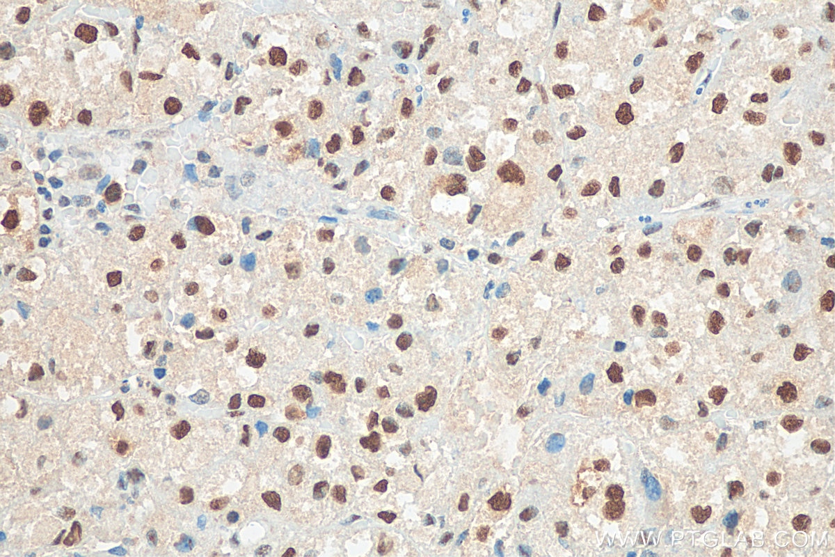 Immunohistochemistry (IHC) staining of human liver cancer tissue using PCNA Polyclonal antibody (10205-2-AP)