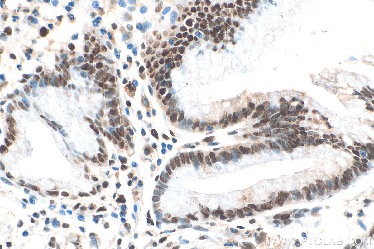 IHC staining of human stomach cancer using 10205-2-AP