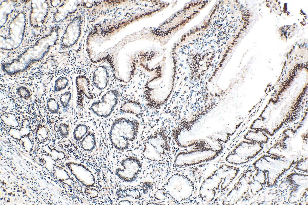 Immunohistochemistry (IHC) staining of human stomach cancer tissue using PCNA Polyclonal antibody (10205-2-AP)