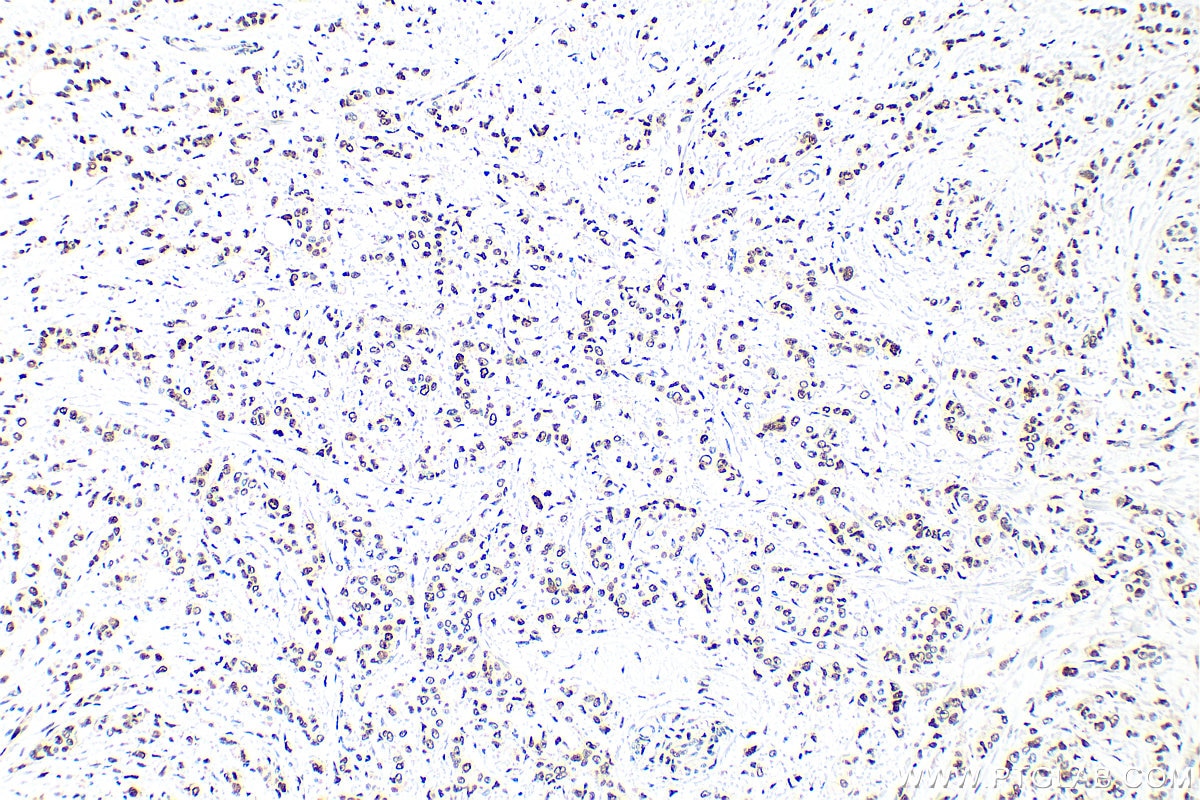 Immunohistochemistry (IHC) staining of human breast cancer tissue using PCNA Polyclonal antibody (10205-2-AP)