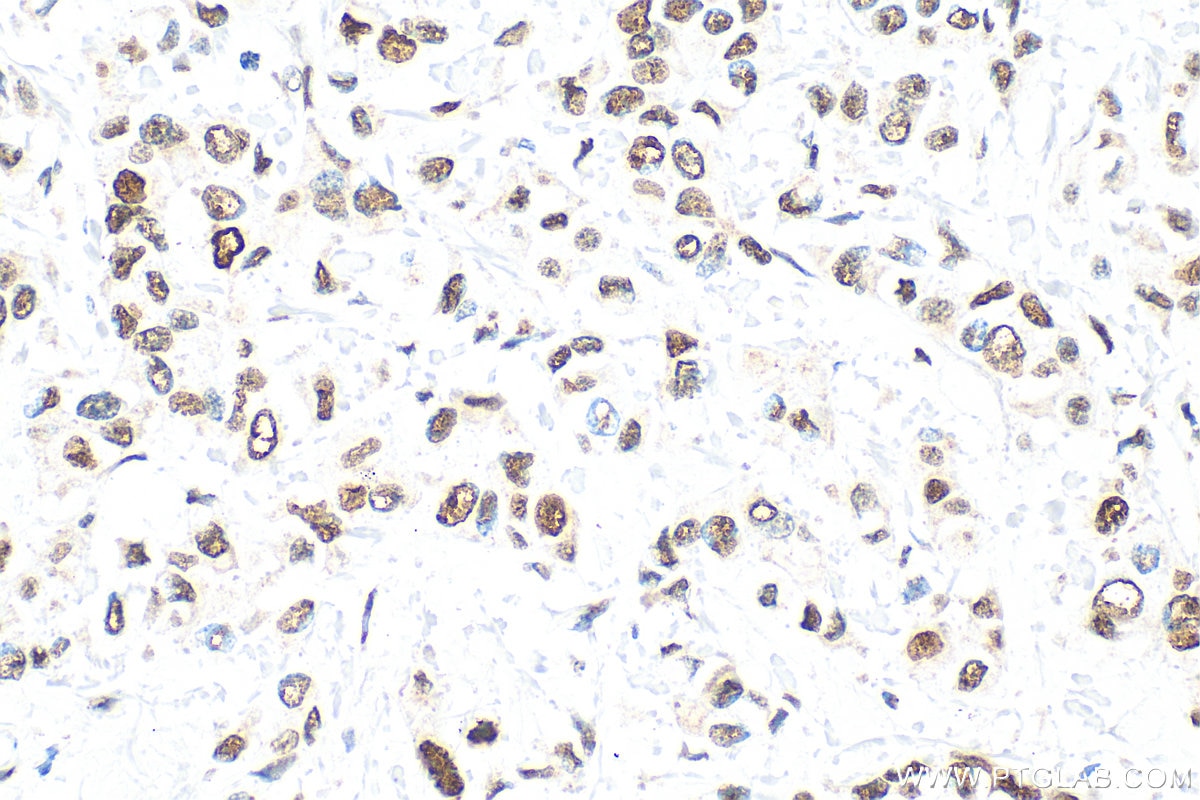 Immunohistochemistry (IHC) staining of human breast cancer tissue using PCNA Polyclonal antibody (10205-2-AP)