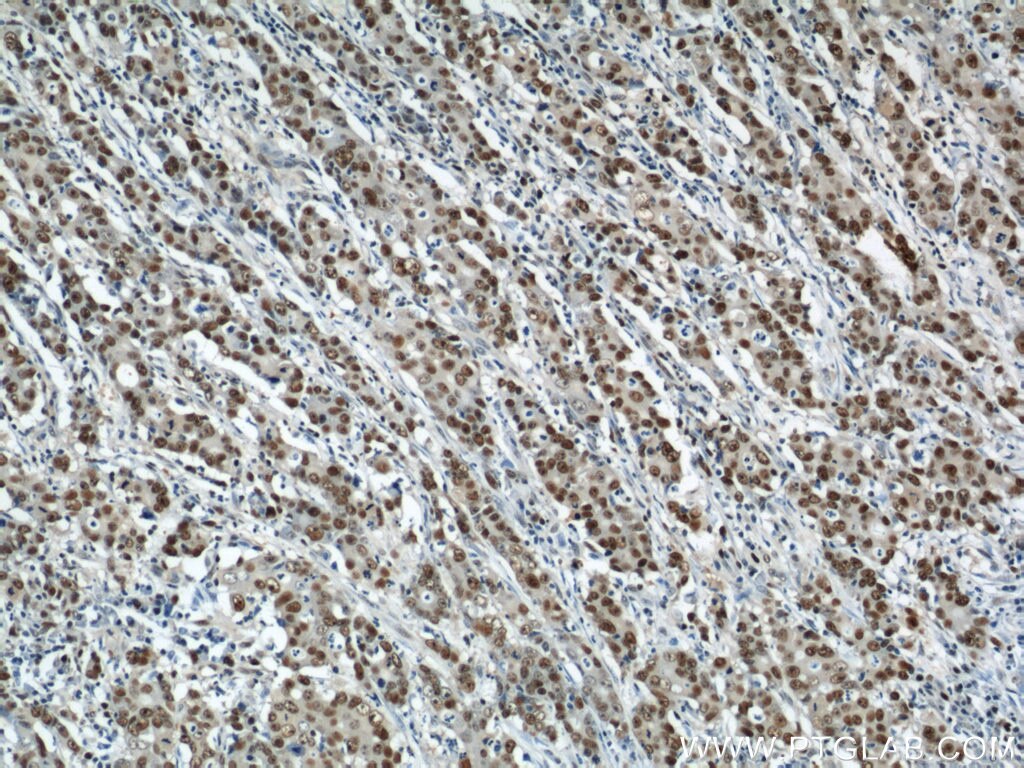 IHC staining of human stomach cancer using 10205-2-AP
