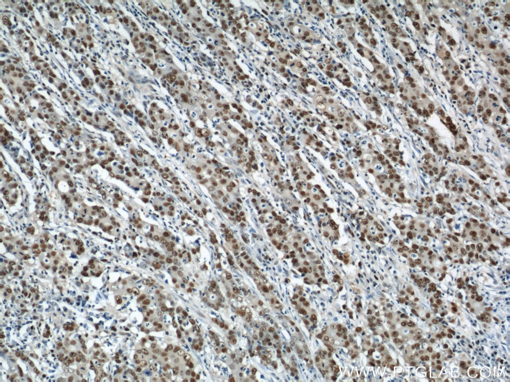 Immunohistochemistry (IHC) staining of human stomach cancer tissue using PCNA Polyclonal antibody (10205-2-AP)