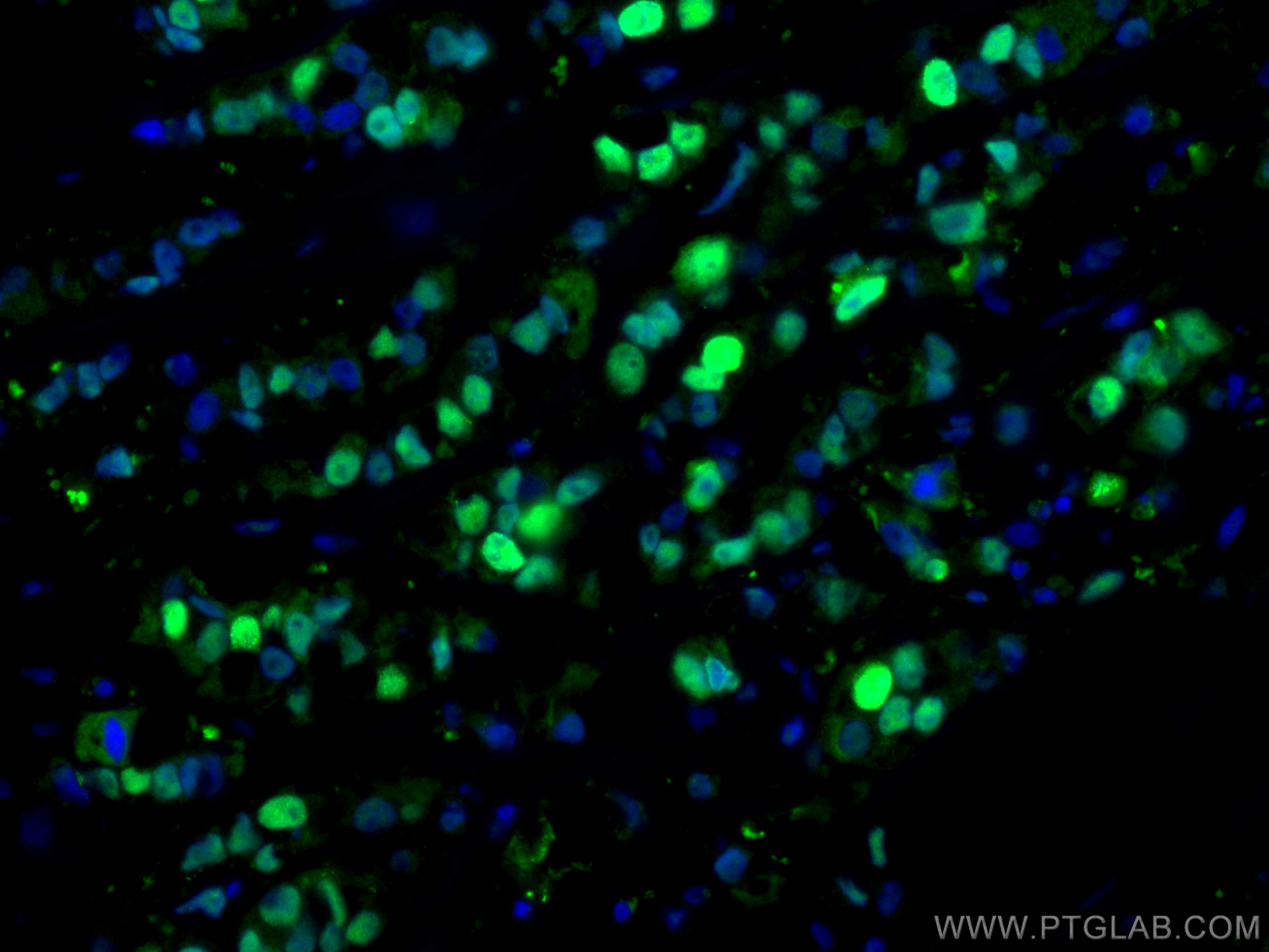 Immunofluorescence (IF) / fluorescent staining of human breast cancer tissue using PCNA Polyclonal antibody (24036-1-AP)