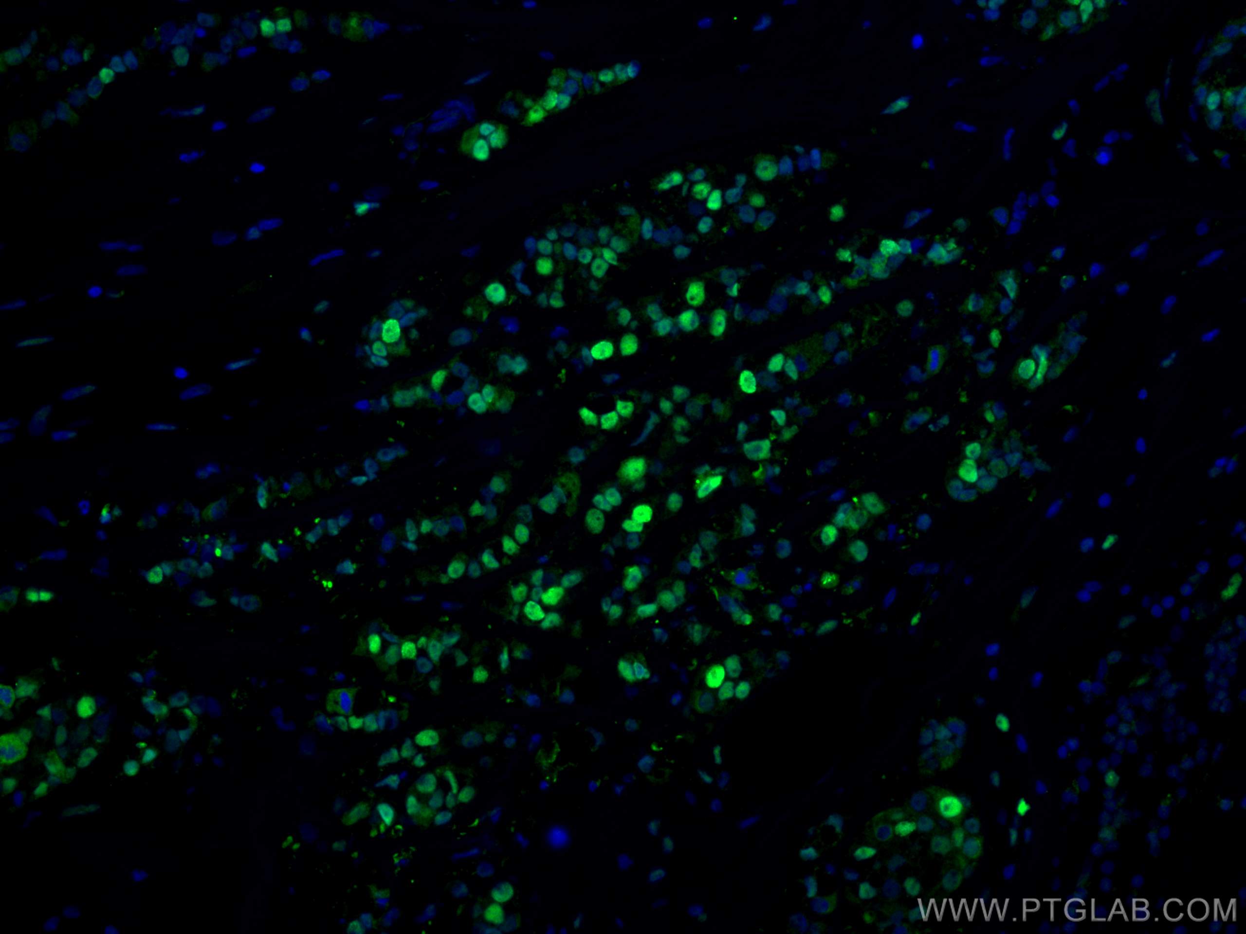 Immunofluorescence (IF) / fluorescent staining of human breast cancer tissue using PCNA Polyclonal antibody (24036-1-AP)