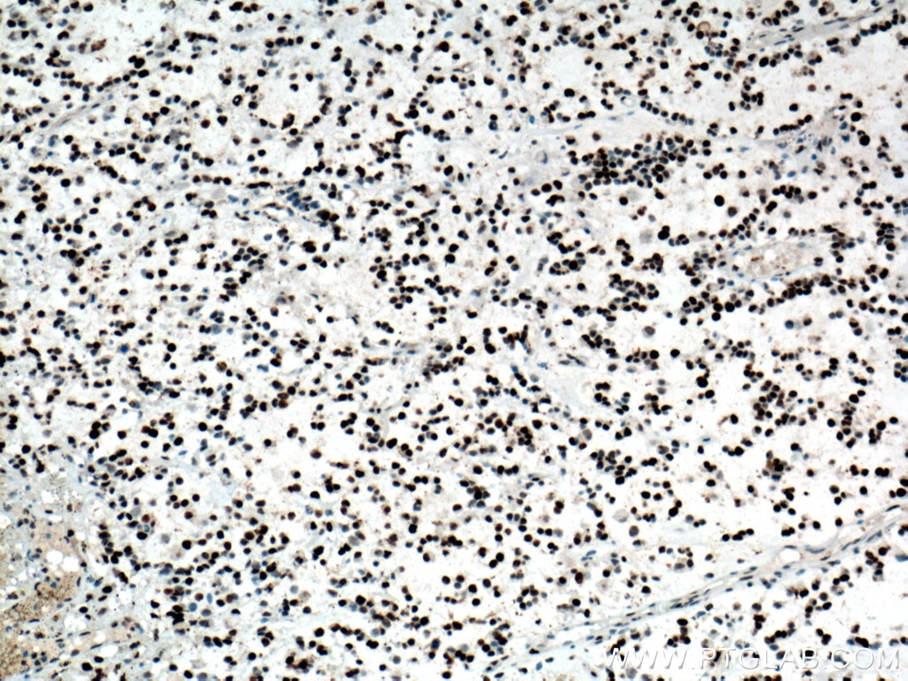 IHC staining of human gliomas using 24036-1-AP