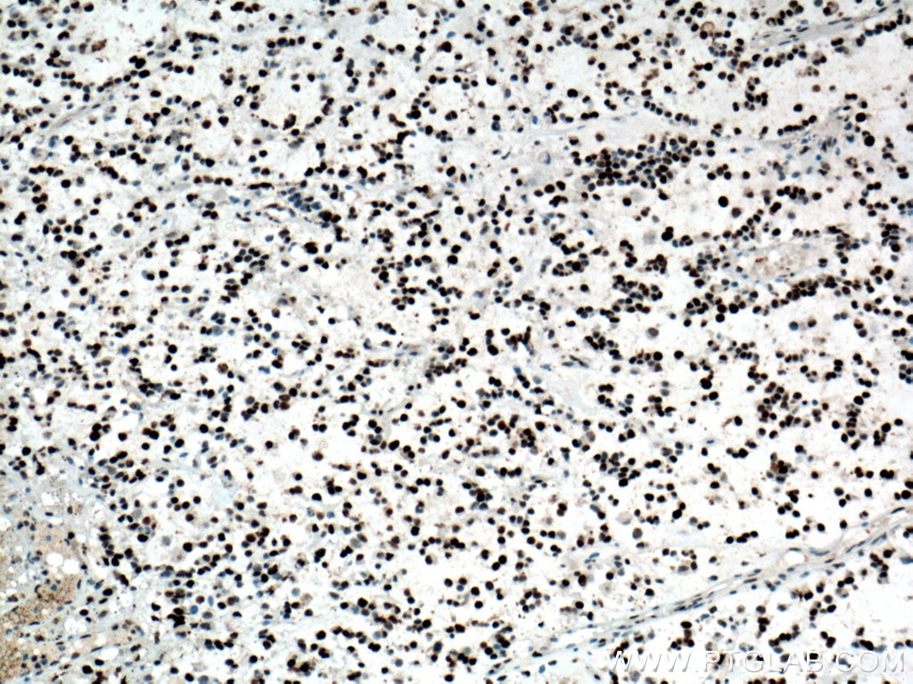 Immunohistochemistry (IHC) staining of human gliomas tissue using PCNA Polyclonal antibody (24036-1-AP)