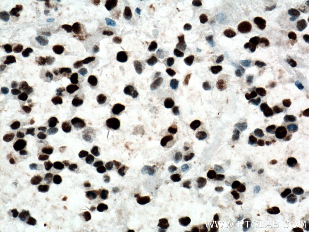 Immunohistochemistry (IHC) staining of human gliomas tissue using PCNA Polyclonal antibody (24036-1-AP)