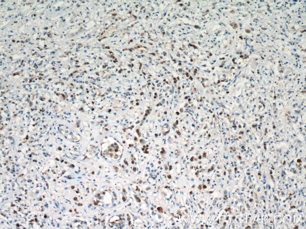 Immunohistochemistry (IHC) staining of human breast cancer tissue using PCNA Polyclonal antibody (24036-1-AP)