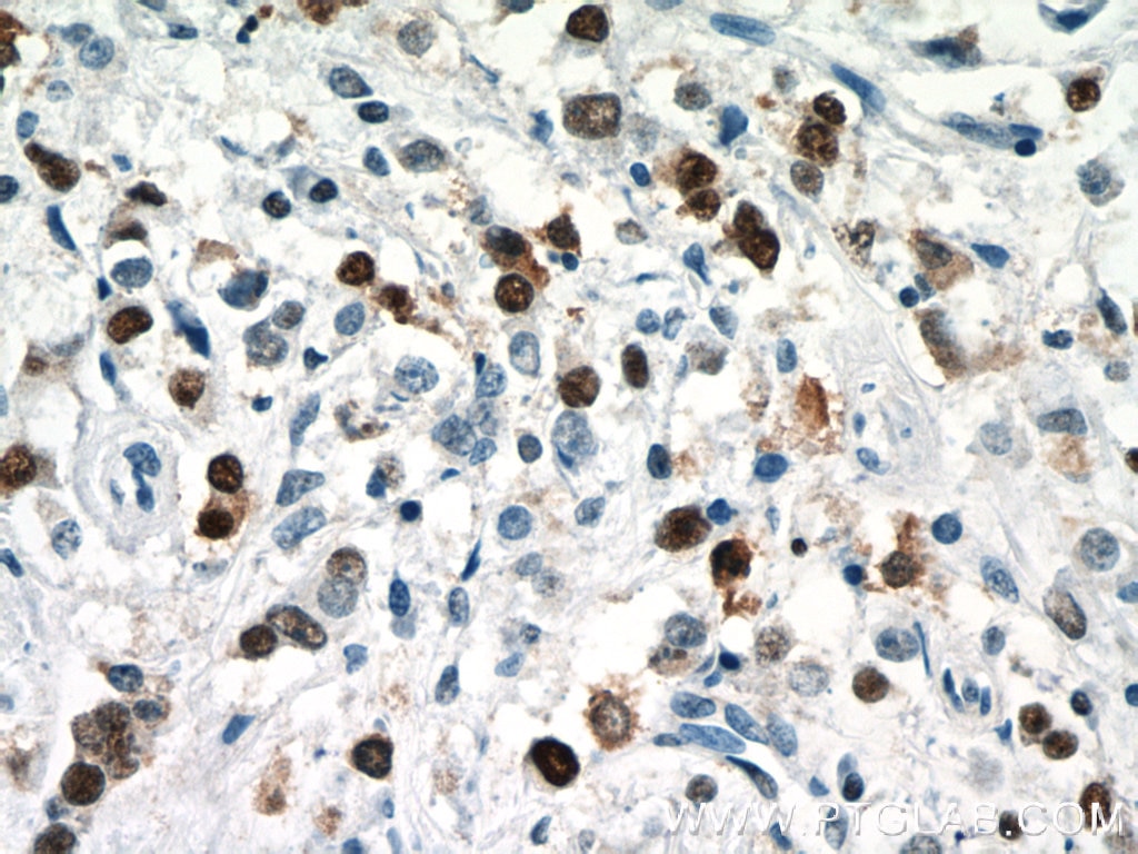 Immunohistochemistry (IHC) staining of human breast cancer tissue using PCNA Polyclonal antibody (24036-1-AP)