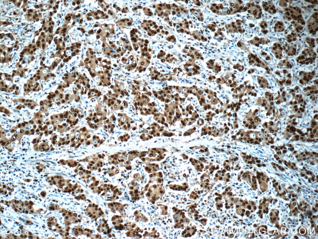 Immunohistochemistry (IHC) staining of human stomach cancer tissue using PCNA Polyclonal antibody (24036-1-AP)