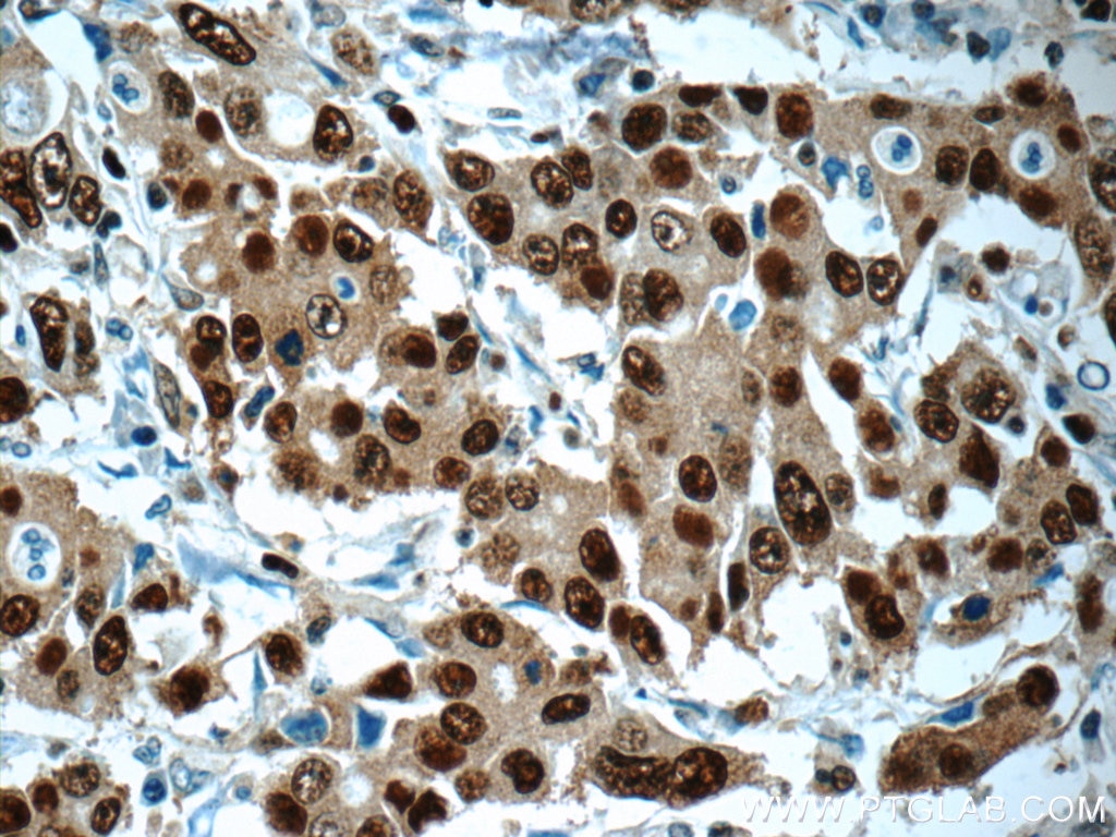 Immunohistochemistry (IHC) staining of human stomach cancer tissue using PCNA Polyclonal antibody (24036-1-AP)
