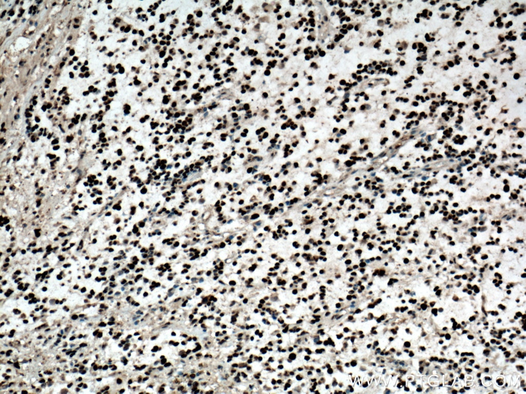Immunohistochemistry (IHC) staining of human gliomas tissue using PCNA Monoclonal antibody (60097-1-Ig)