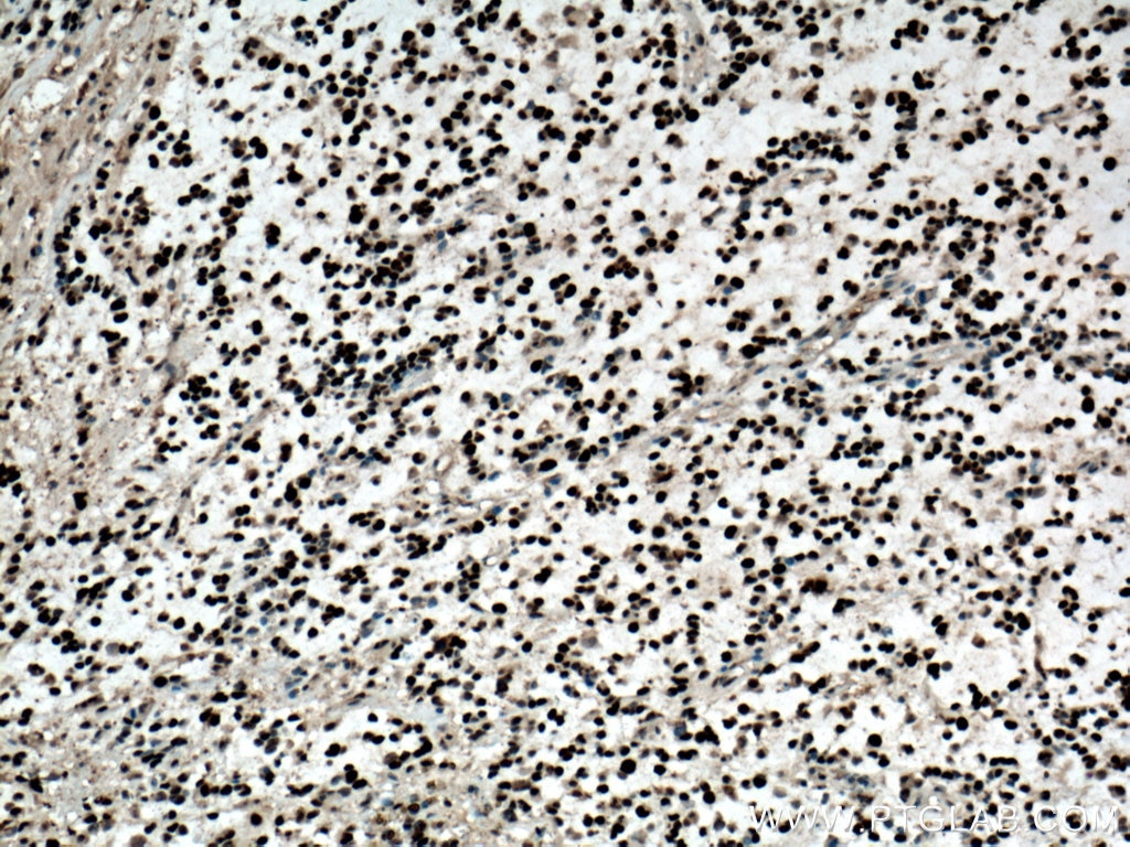 IHC staining of human gliomas using 60097-1-Ig