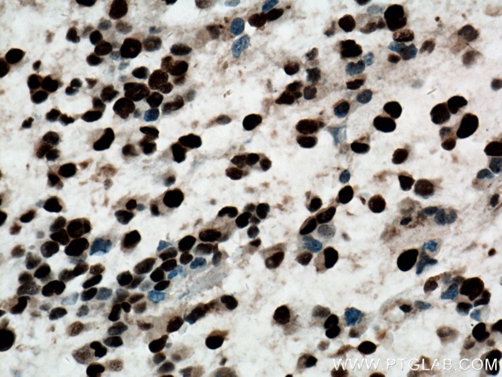 IHC staining of human gliomas using 60097-1-Ig