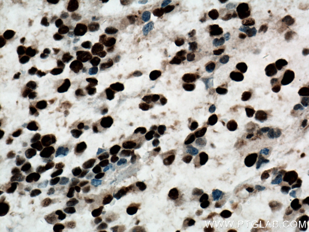 Immunohistochemistry (IHC) staining of human gliomas tissue using PCNA Monoclonal antibody (60097-1-Ig)