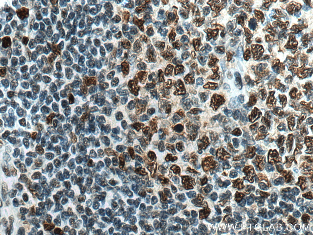 IHC staining of human tonsillitis using 60097-1-Ig