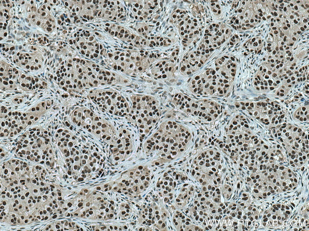 Immunohistochemistry (IHC) staining of human breast cancer tissue using PCNA Monoclonal antibody (60097-1-Ig)